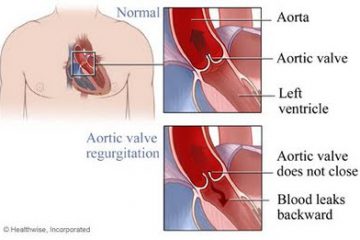 Liều lượng uống Giảo cổ lam như thế nào để điều trị huyết áp thấp? 
